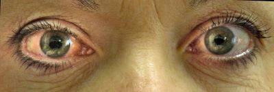 "glaucoma" picture