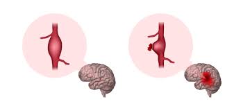 "aneurysm" picture