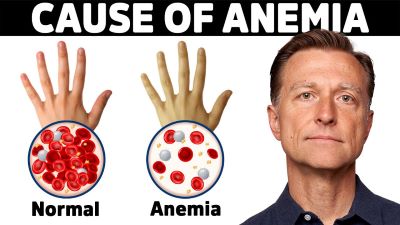 "anemia" picture