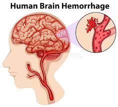 "haemorrhage" picture