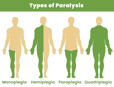 "paraplegia" picture