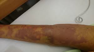 "sepsis" picture