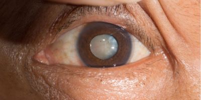 "cataract" picture