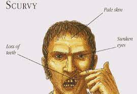 "scurvy" picture