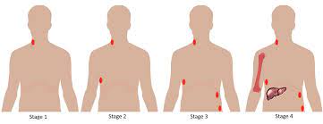 "lymphoma" picture