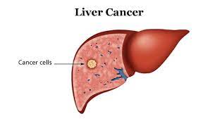"liver cancer" picture