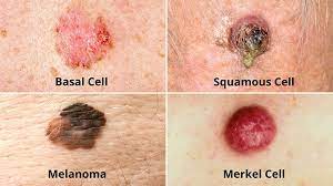 "basal cell carcinoma" picture