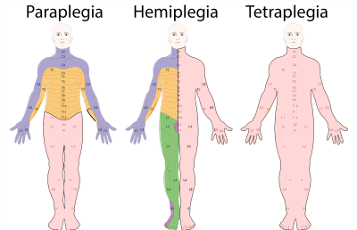 "quadriplegia" picture