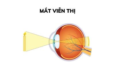 "longsightedness" picture