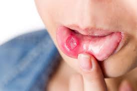 "canker" picture