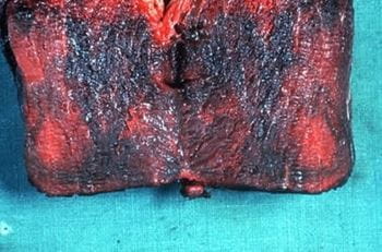 "blackleg" picture