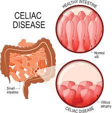 "celiac" picture