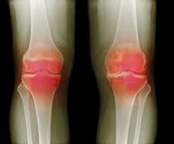 "arthritic" picture