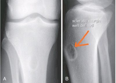 "sclerotic" picture