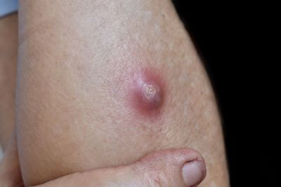 "cyst" picture