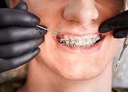 "orthodontics" picture