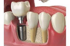 "prosthodontics" picture