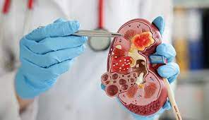 "nephrology" picture