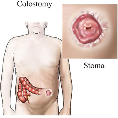 "colostomy" picture