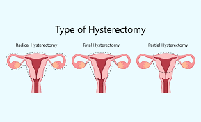"hysterectomy" picture
