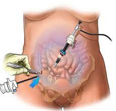 "laparoscopy" picture