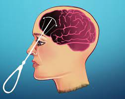 "lobotomy" picture