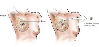 "lumpectomy" picture