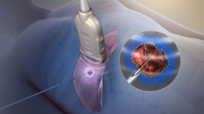 "ablation" picture