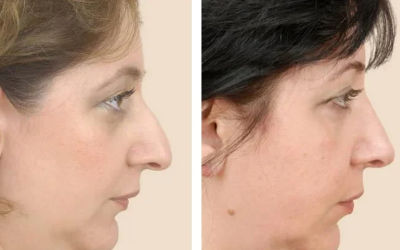 "rhinoplasty" picture