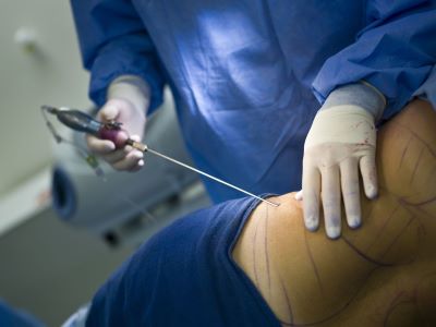 "liposuction" picture