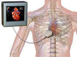 "echocardiogram" picture