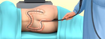 "colonoscopy" picture