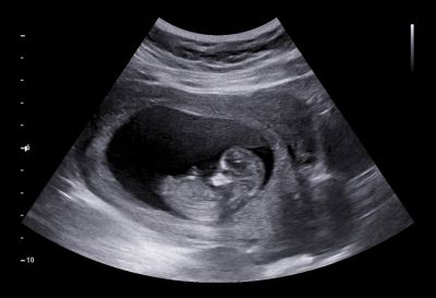"ultrasound" picture