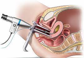 "hysteroscopy" picture