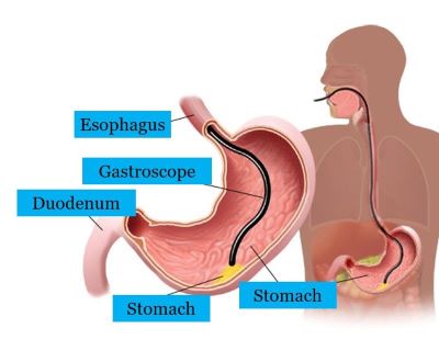 "gastroscopy" picture
