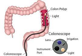 "sigmoidoscopy" picture