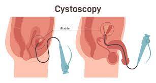 "cystoscopy" picture