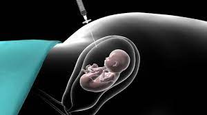 "amniocentesis" picture