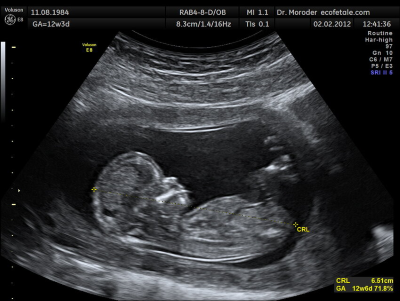 "sonogram" picture