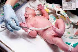 "umbilical cord" picture