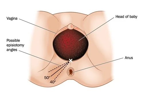 "episiotomy" picture