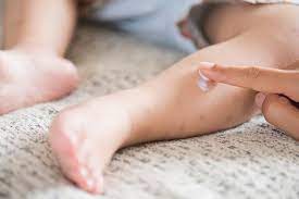 "calamine lotion" picture