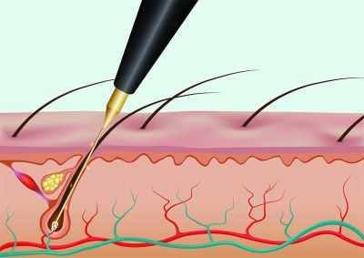 "electrolysis" picture