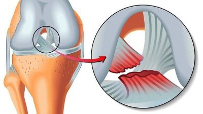 "ACL" picture