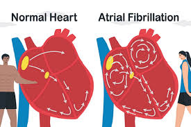 "afib" picture