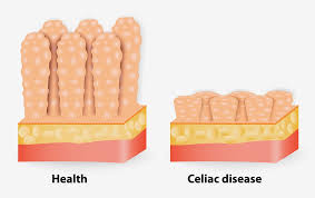 "coeliac disease" picture