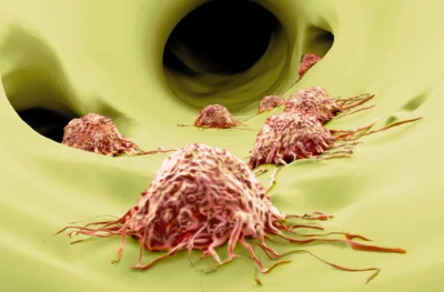 "metastasis" picture