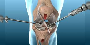 "arthroscopy" picture