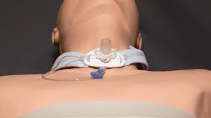 "tracheostomy" picture