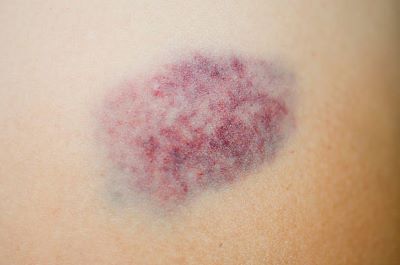 bruised ne anlama geliyor? | Lingoland İngilizce-Türkçe Sözlük